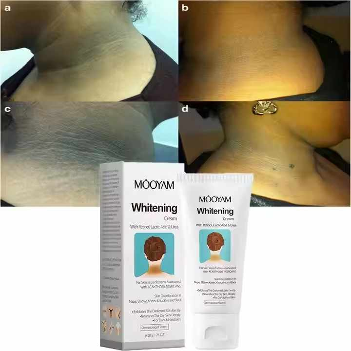 Nigricans Whitening Cream for Knee, Elbow, Neck, Underarm