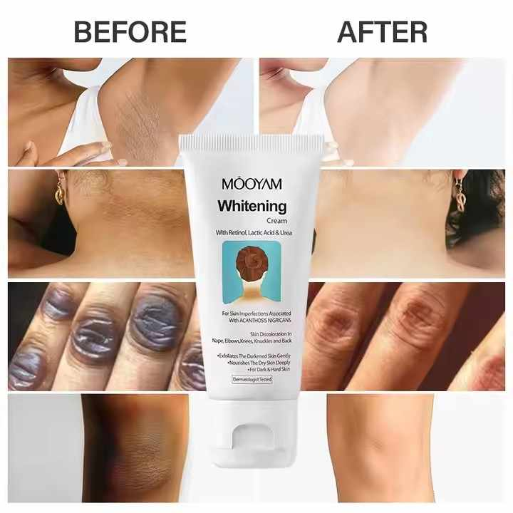 Nigricans Whitening Cream for Knee, Elbow, Neck, Underarm