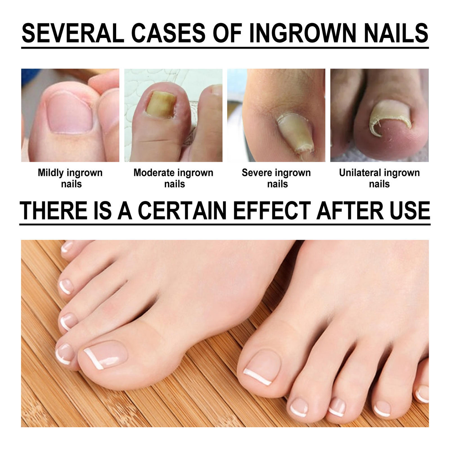 Southmoon Ingrown Toenail Drops Nail Repair Oil (BUY 1 GET 1 FREE🔥🔥)