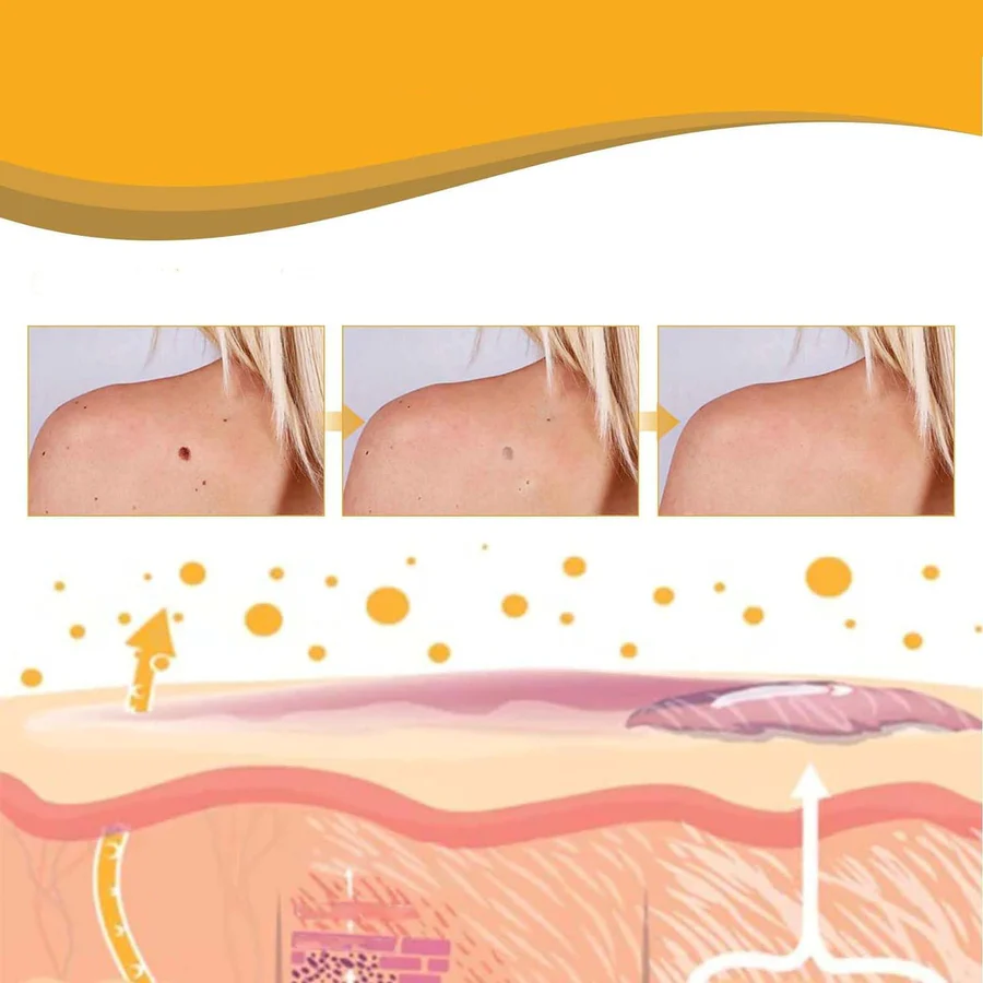 Original Bee Venom Wart & Skin Tag Remover Spray -(Buy 1 Get 1 FREE🔥🔥)